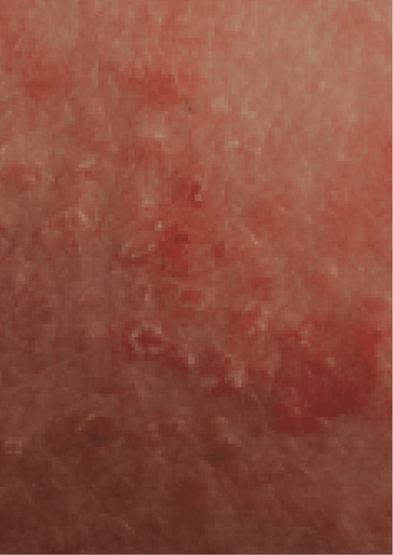 Dry or scaly skin due to moderate-to-severe eczema.