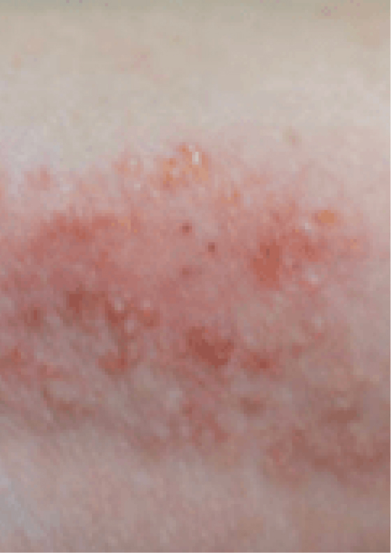 Small raised bumps on skin due to moderate-to-severe eczema.