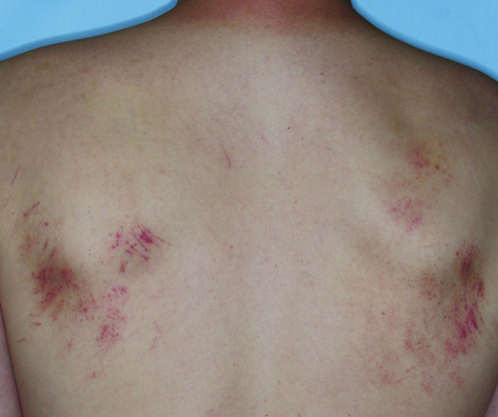 Comparison of inflamed skin on a back with atopic dermatitis (eczema) before and after Adbry® treatment.