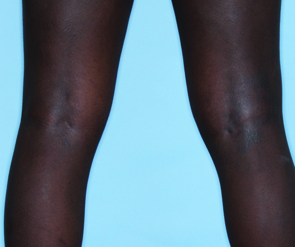 Comparison of inflamed skin on legs with atopic dermatitis (eczema) before and after Adbry® treatment.