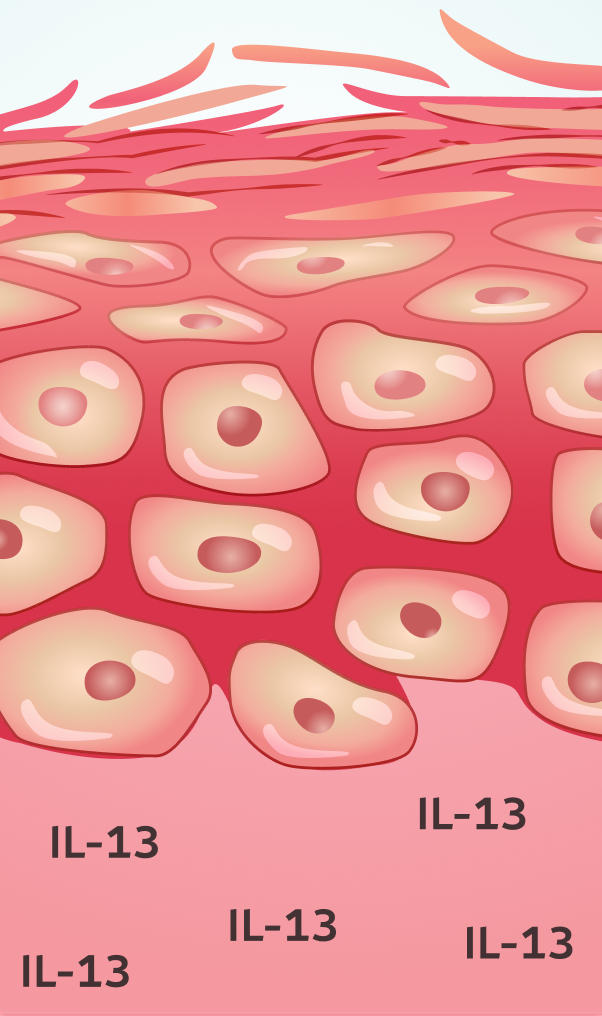 Eczema skin with damage and increased IL-13.