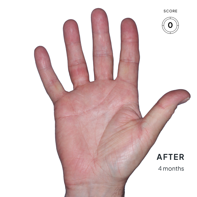 Before-and-after image of a hand showing skin improvement after 4 months of Anzupgo® treatment