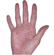 Small thumbnail of hand showing irritation before Anzupgo® treatment