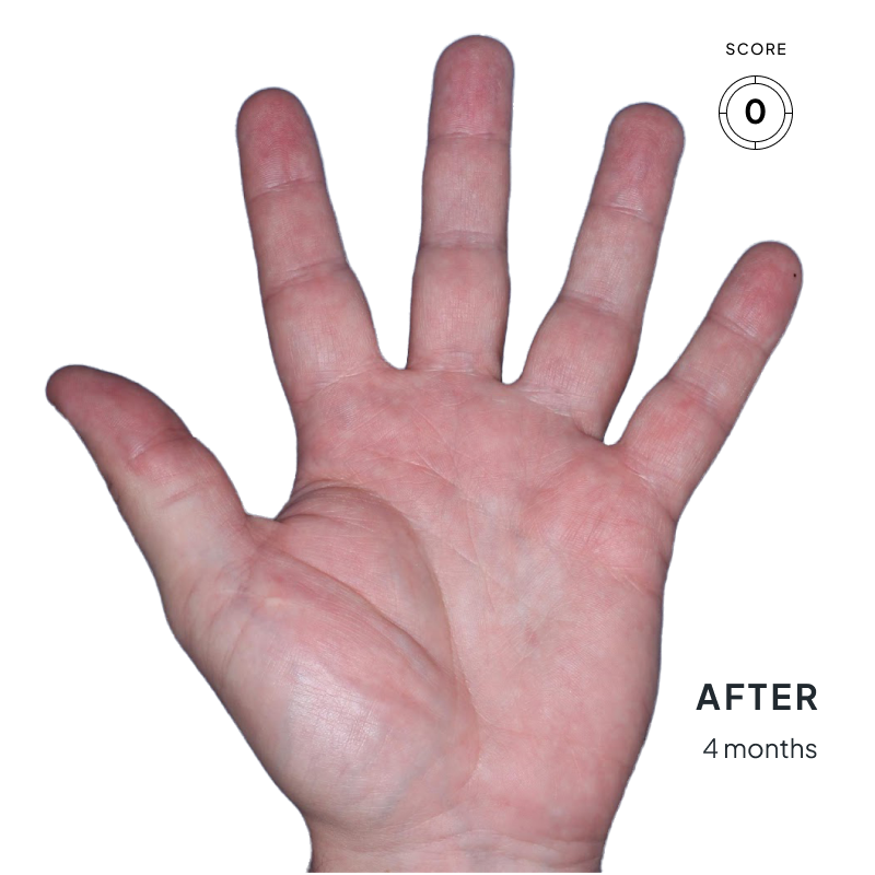 Before-and-after image of chronic hand eczema showing improvement from score 4 to 0 after 4 months of Anzupgo® treatment