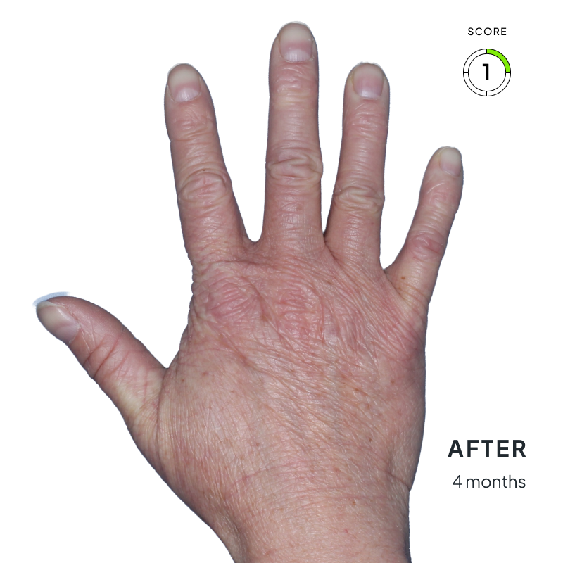 Before and after image showing improved skin texture and reduced inflammation after 4 months of Anzupgo® use