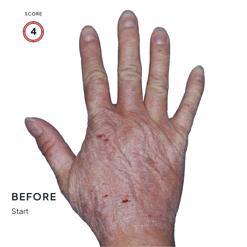 Before and after image showing improved skin texture and reduced inflammation after 4 months of Anzupgo® use
