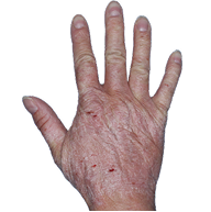 Small thumbnail of hand with inflamed, scaly skin before Anzupgo® treatment