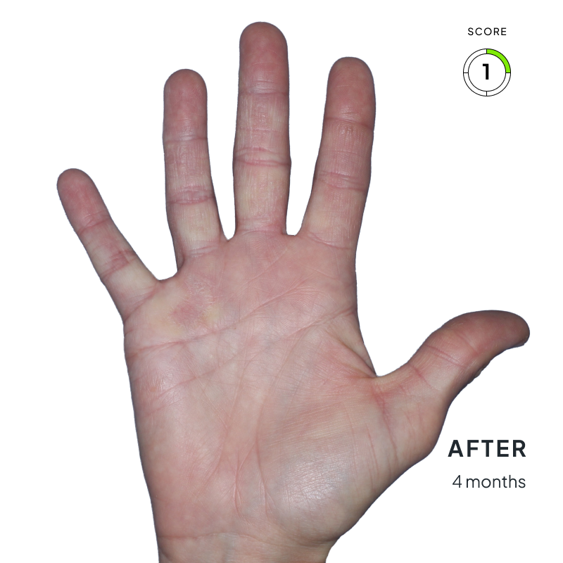 Before-and-after comparison showing chronic hand eczema improvement from score 3 to score 1 after 4 months of Anzupgo® treatment