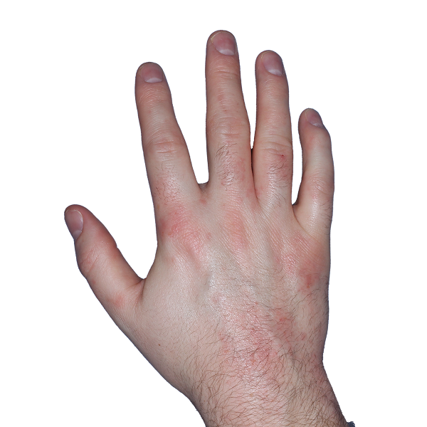Case 2, Week 4: IGA-CHE score: 3. HESD-Itch score: 3.3. HESD-Pain score: 3.3