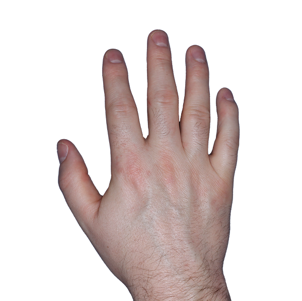 Case 2, Week 8: IGA-CHE score: 1. HESD-Itch score: 2.2. HESD-Pain score: 1.5