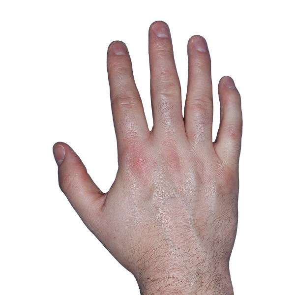 Case 2, Week 16: IGA-CHE score: 1. HESD-Itch score: 1.3. HESD-Pain score: 1.6