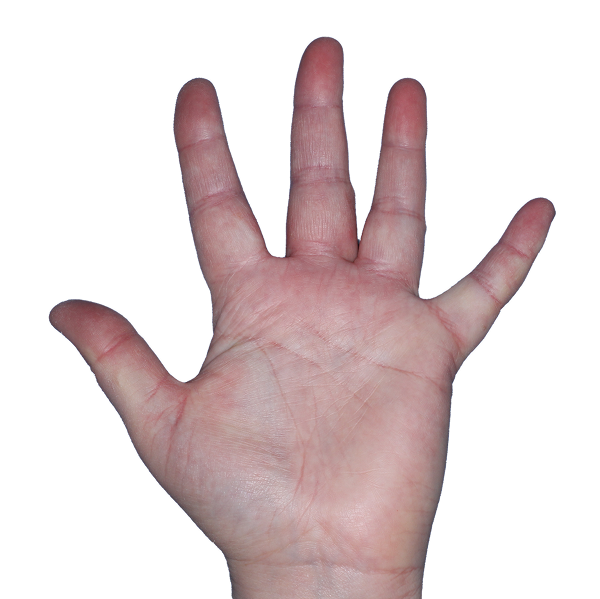 Case 3, Week 4: IGA-CHE score: 2. HESD-Itch score: 3.1. HESD-Pain score: 2.3