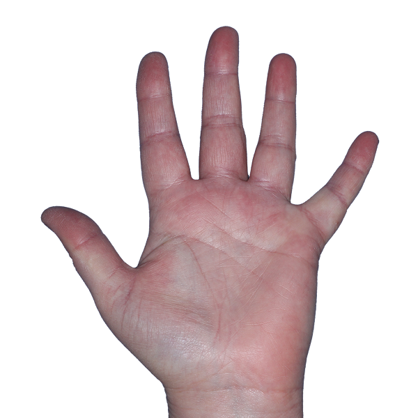 Case 3, Week 8: IGA-CHE score: 1. HESD-Itch score: 0.9. HESD-Pain score: 2.9