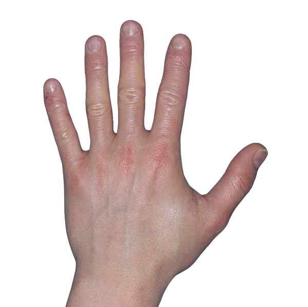 Case 4: At Baseline, patient has erythema and vesicles. IGA-CHE score: 4. HESD-Itch score: 6.7. HESD-Pain score: 6.7