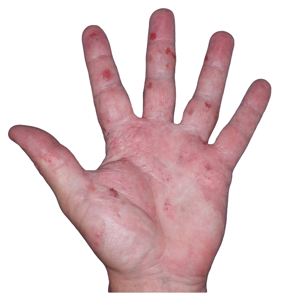 Case 3: At Baseline, patient has vesicles, erythema, and erosions. IGA-CHE score: 4. HESD-Itch score: 7.6. HESD-Pain score: 7.3.