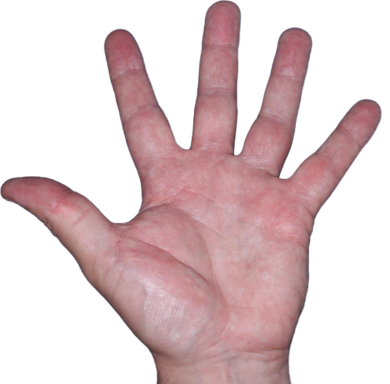 Case 3, Week 8: IGA-CHE score: 2. HESD-Itch score: 2. HESD-Pain score: 1.3