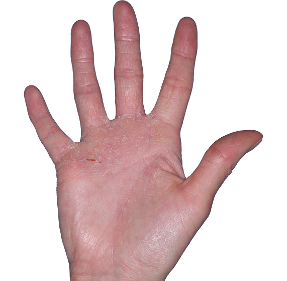 Case 4, Week 8: IGA-CHE score: 3. HESD-Itch score: 2.9. HESD-Pain score: 2.9