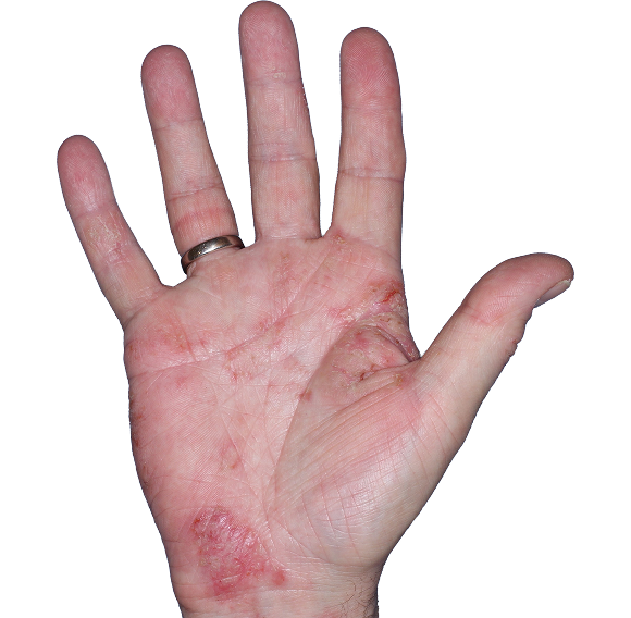 Case 5: At Baseline, patient has erythema, scaling, and fissure. IGA-CHE score: 3. HESD-Itch score: 6.1. HESD-Pain score: 6.3