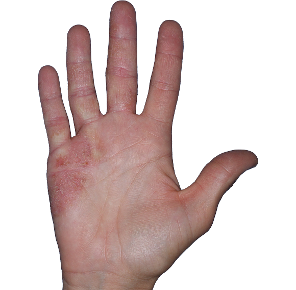 Case 6: At Baseline, patient has erythema and scaling. IGA-CHE score: 3. HESD-Itch score: 7.7. HESD-Pain score: 6.1