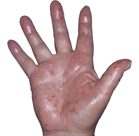 Case 7: At Baseline, patient has vesicles, erythema, and edema. IGA-CHE score: 3. HESD-Itch score: 6.8. HESD-Pain score: 6.5.