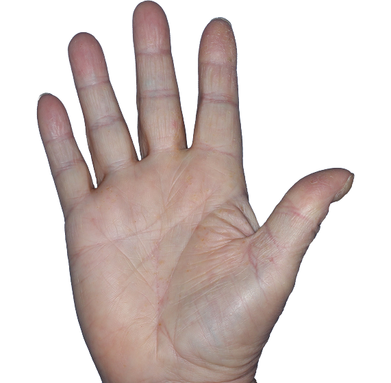 Case 7, Week 16: IGA-CHE score: 1. HESD-Itch score: 2. HESD-Pain score: 2.1